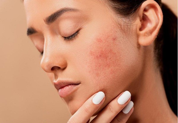 Hỗ trợ điều trị mụn