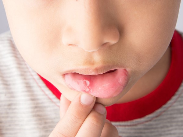Có thể dùng như nước súc miệng trong quá trình điều trị loét miệng