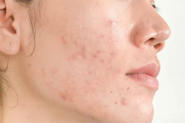 Các dấu hiệu và triệu chứng của dị ứng hương liệu