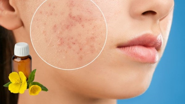 Người bị dị ứng với dầu hoa anh thảo