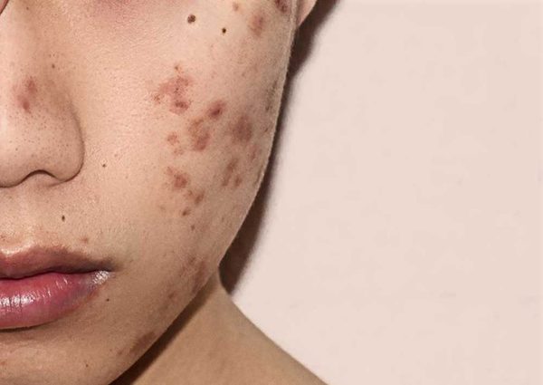 Điều trị mụn và vết thâm